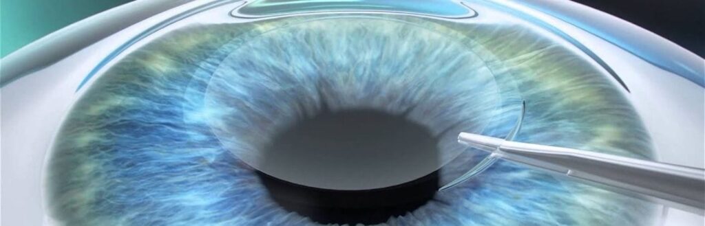 Excimer Laser Nedir ve Nasıl Çalışır?