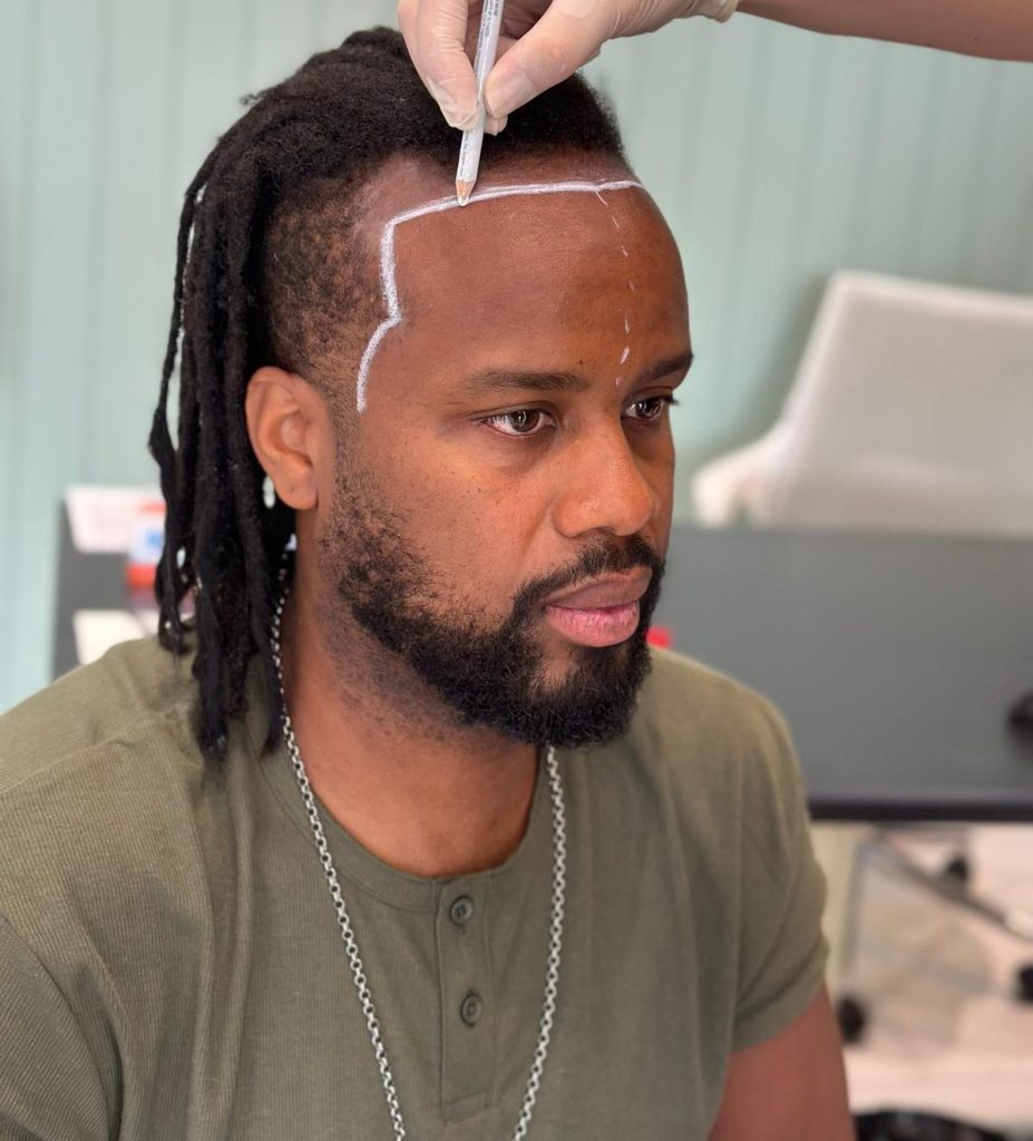 What is Afro Hair Transplantation?