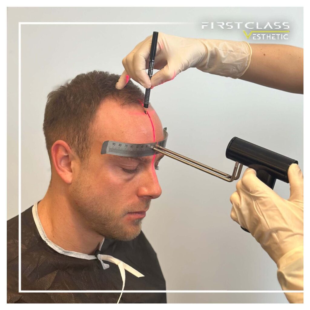 Hair Transplant