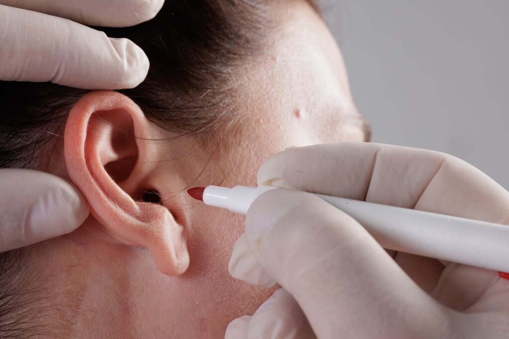 The doctor surgeon is preparing for the operation Otoplasty, Ear plastic surgery,